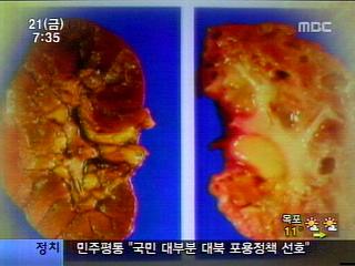 '콩팥' 위험하다